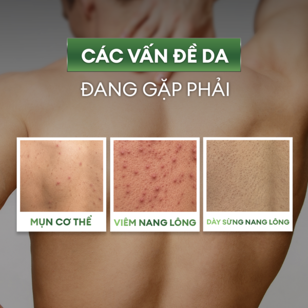 4-1420a1d1-1a71-40c8-9341-c8f41e9b7630 Xịt giảm mụn và mờ thâm cơ thể Exfoliating Body Spray 100ml