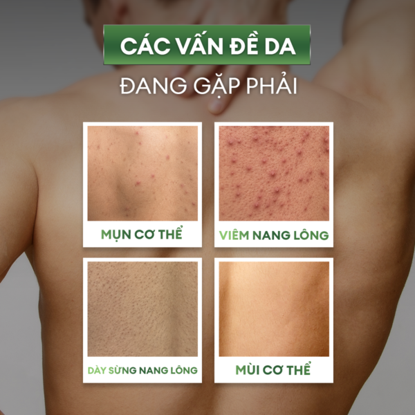 5-07a384de-569d-4b65-884e-acd81f15388b Combo Sữa tắm mụn lưng 250ml và Xịt mụn lưng 100ml