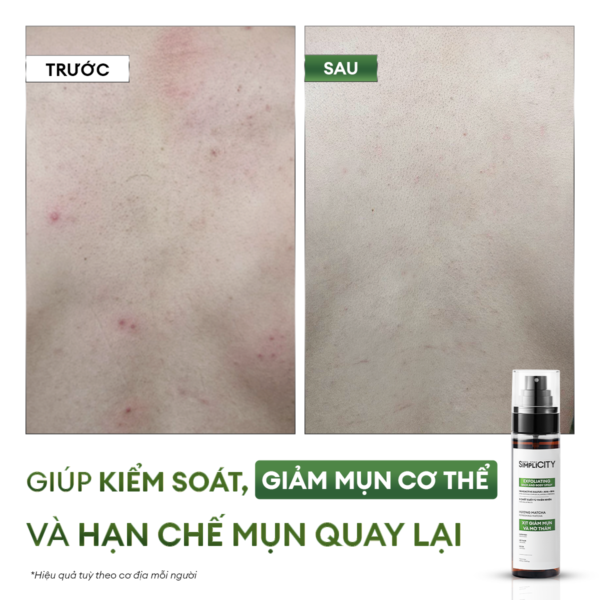 5-b0353bf3-9624-4181-940a-52ee73d95781 Xịt giảm mụn và mờ thâm cơ thể Exfoliating Body Spray 100ml