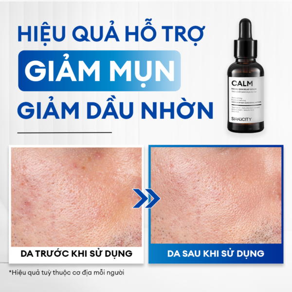 Combo chăm da dầu mụn Acne Trio