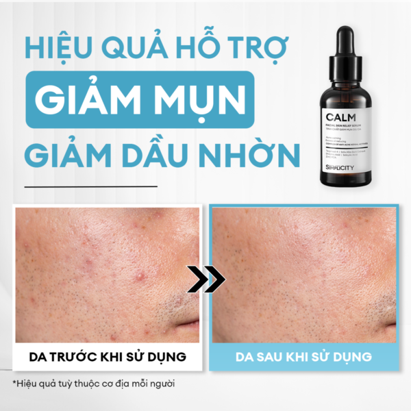 hie-u-qua Serum giảm mụn & làm dịu da Calm 30ml