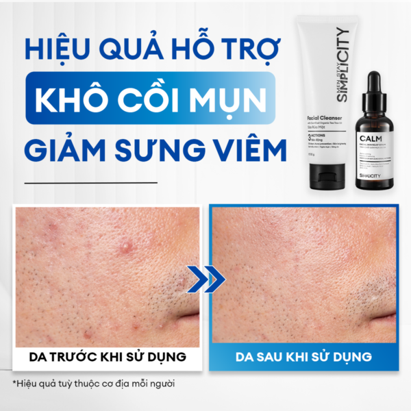 hie-u-qua-c70457f1-bc68-4166-9426-4a90fe48a18d Combo giảm mụn sưng viêm Acne Duo