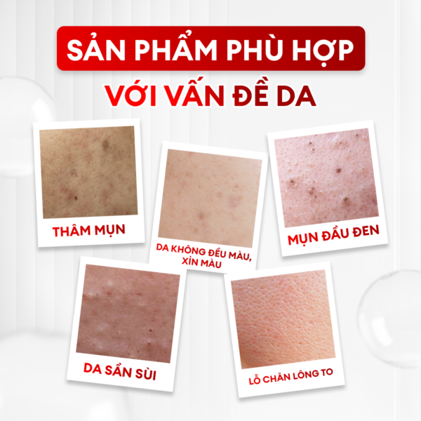 va-n-de-069ca9b1-24e3-4d74-8a3a-6e346f275be3 Combo serum giảm mụn mờ thâm Calm và Vital