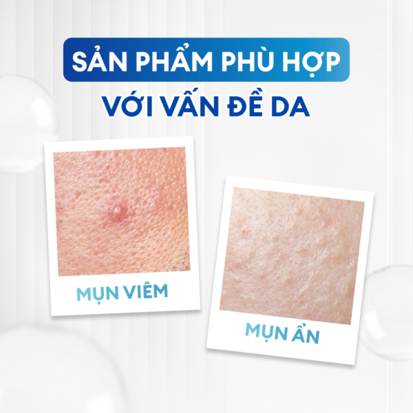 va-n-de-773e9f78-4076-4969-8618-2fcadd81688d Combo giảm mụn sưng viêm Acne Duo